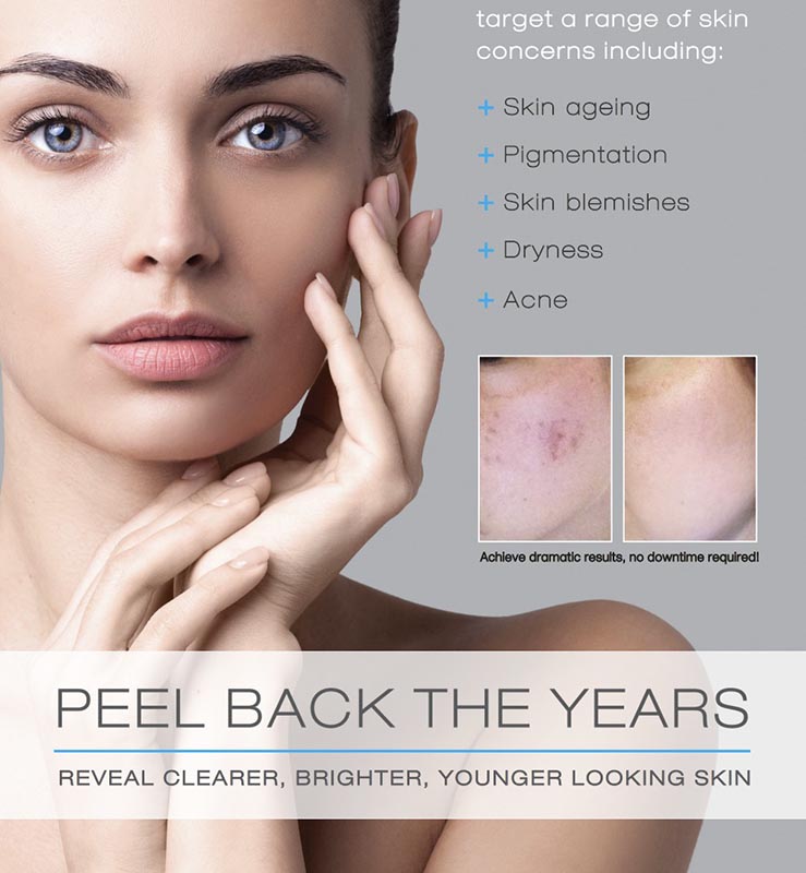 Chemical Peels