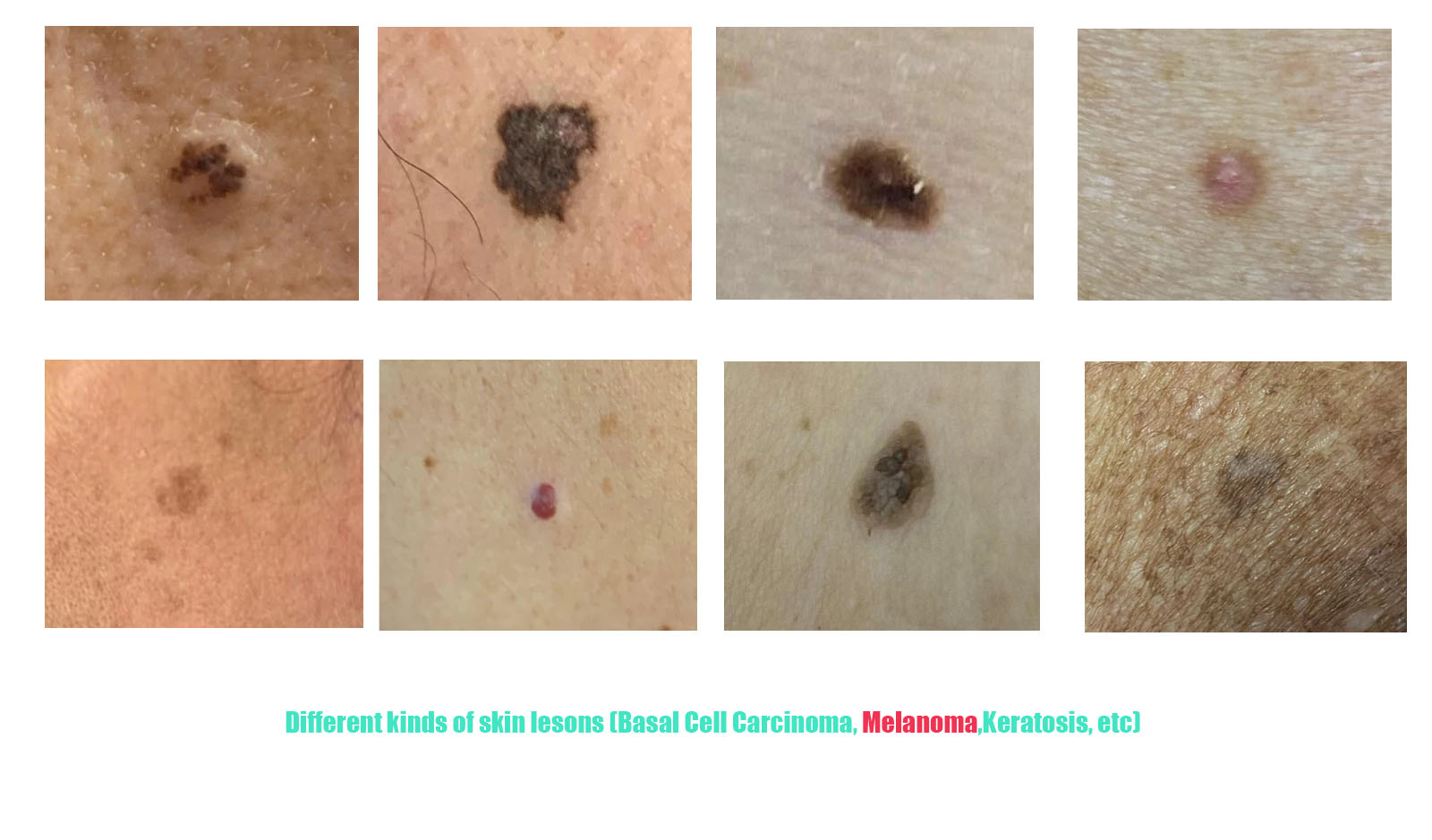 Skin Cancer Checks